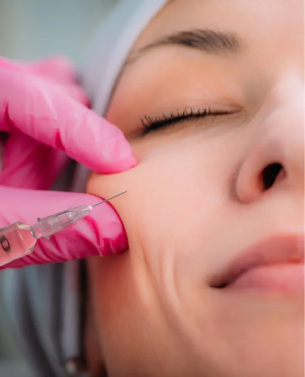 Filler for Cheeks