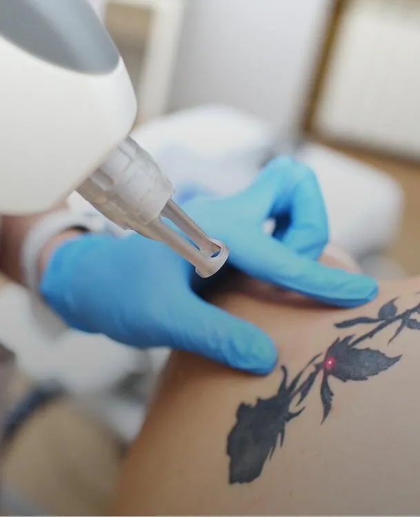<p>Tattoo Removal, Pigmentation Treatment</p>
 image