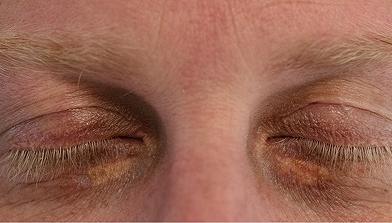 What is xanthelasma?