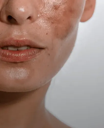 <p>Anti-Aging & Wrinkles reduction<br />
Skin Tightening<br />
Acne and post traumatic scars<br />
Stretch marks</p>
 image