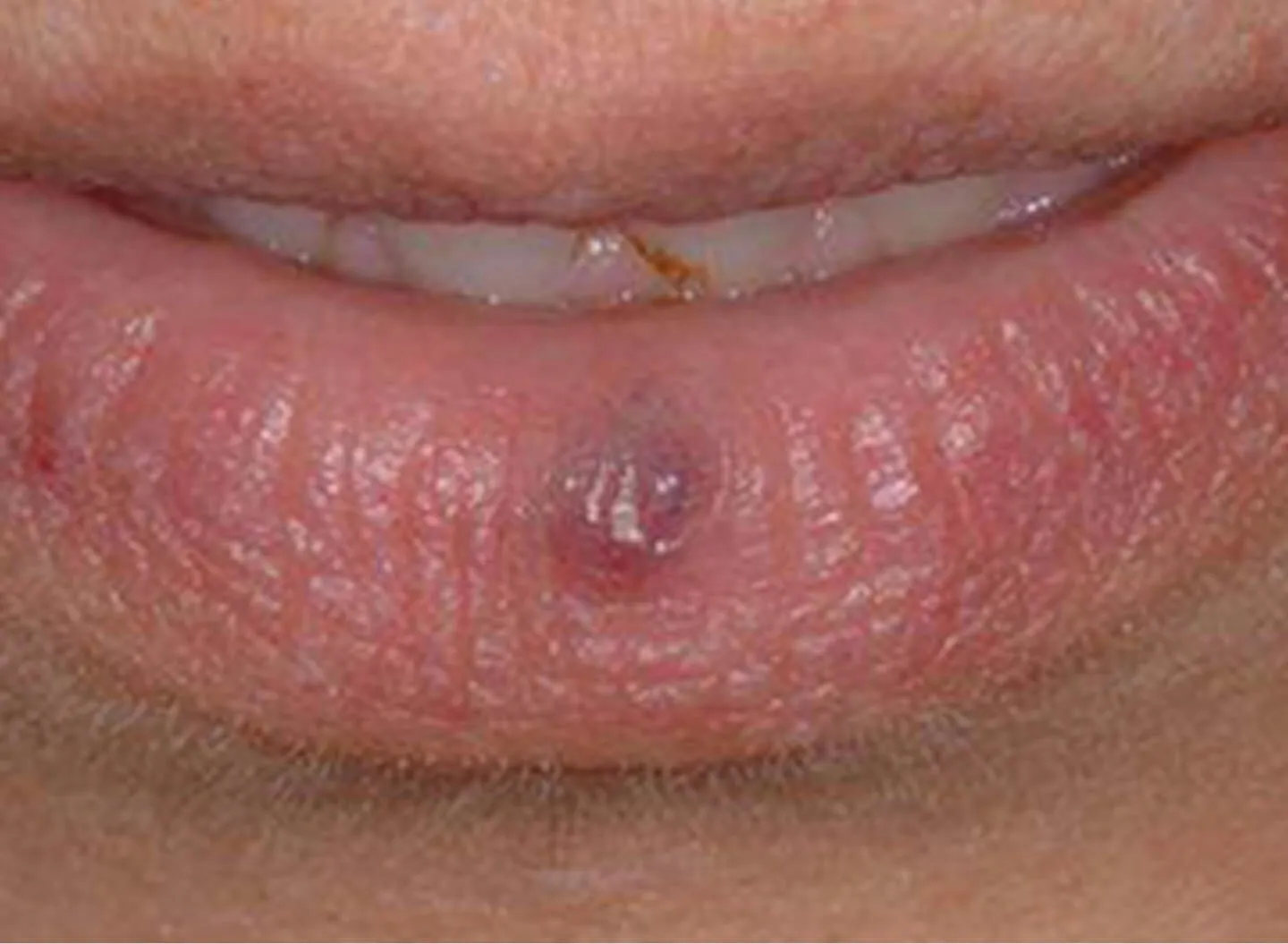 Cherry Angiomas