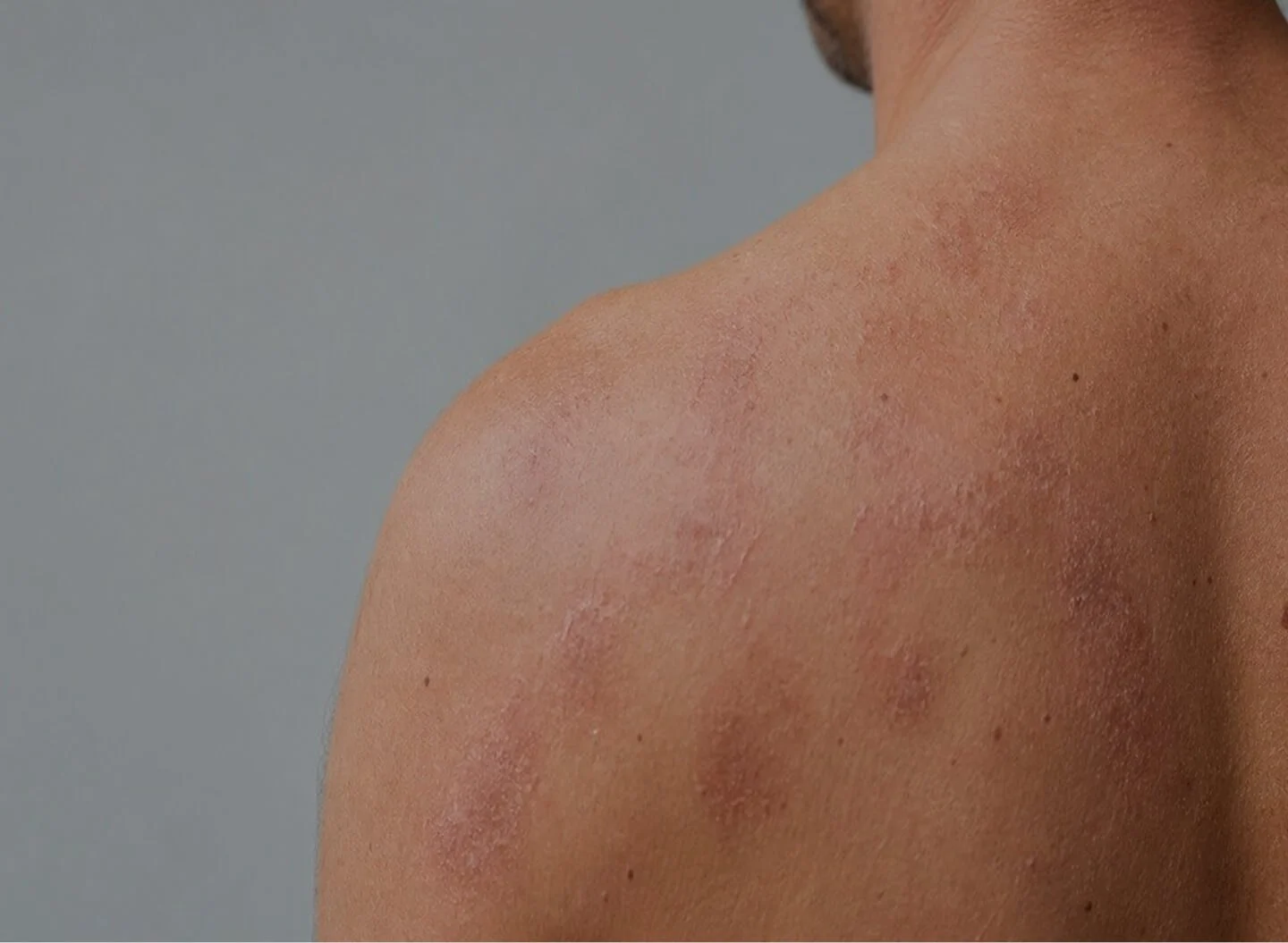 Eczema