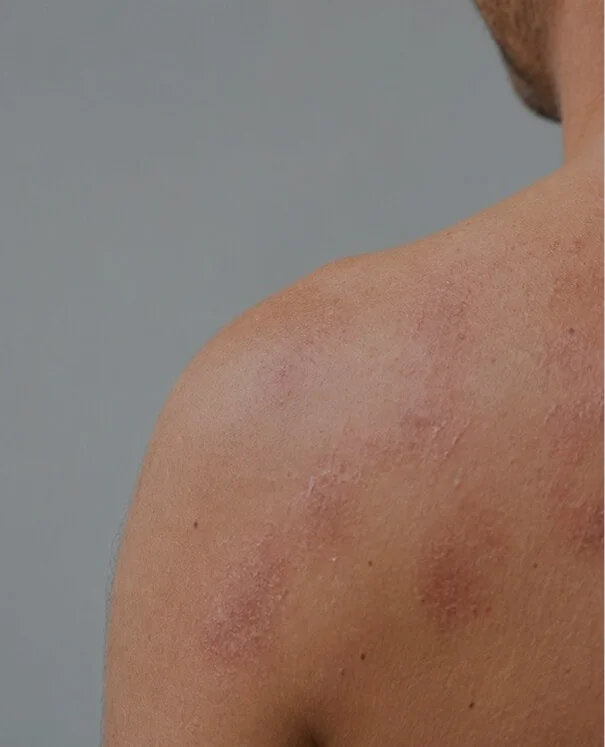 Eczema s Eczema - rtwskin clinic