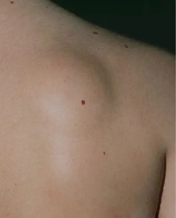 Lipomas small