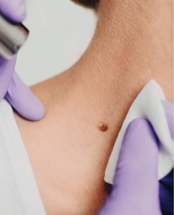 Checking Moles