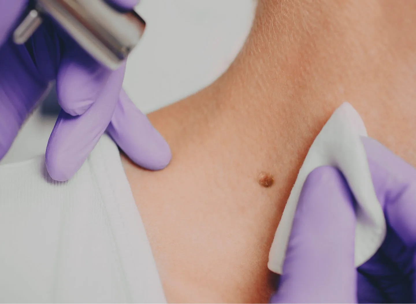 Checking Moles