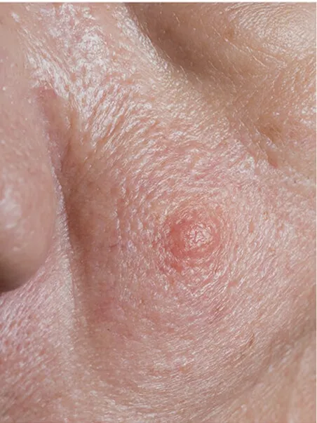 Sebaceous hyperplasia (1)