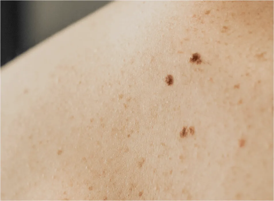 Seborrhoeic Keratosis