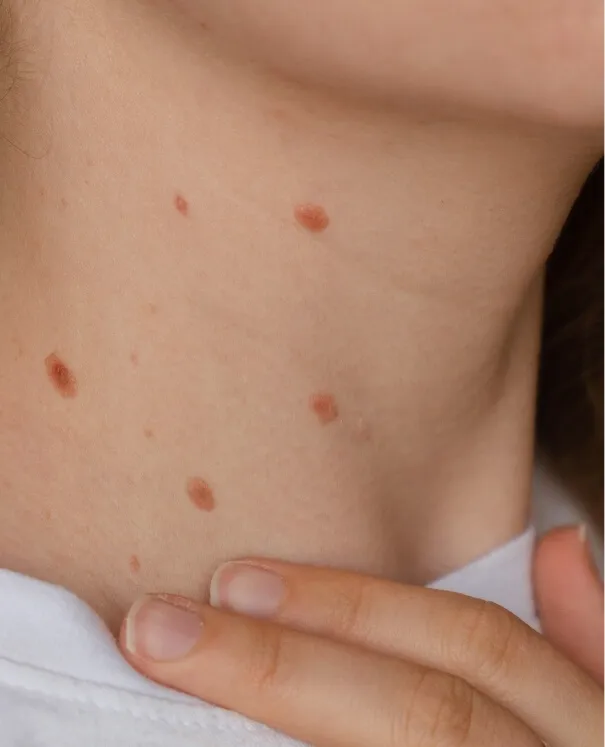 Skin Tag small