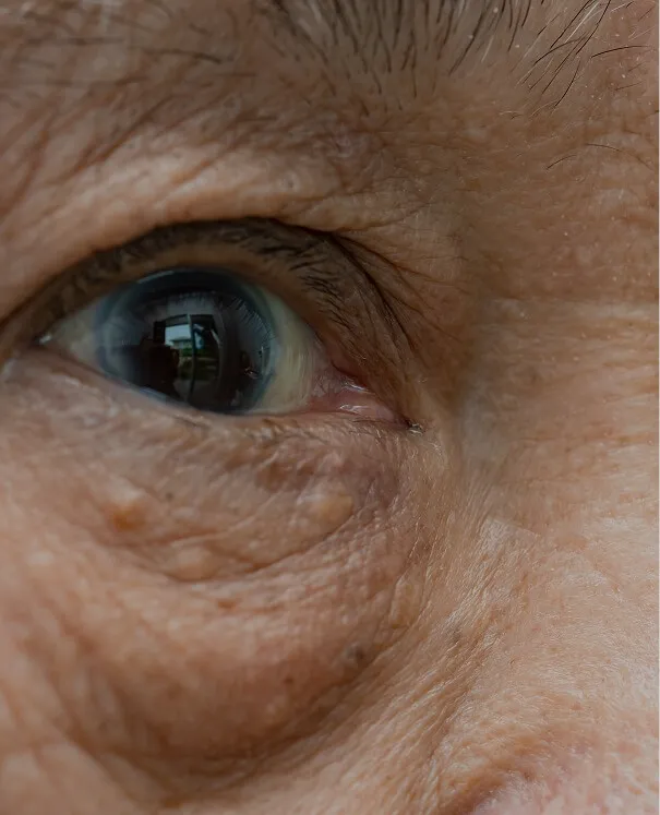 Syringoma