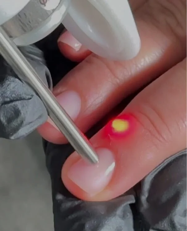 Wart and Verucca Wart and Verruca - rtwskin clinic