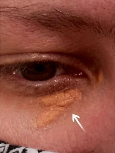 Xanthelasma treatment in action before result