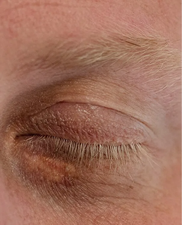 Xanthelasma small