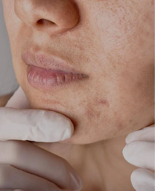 Acne scarring Acne scarring - rtwskin clinic