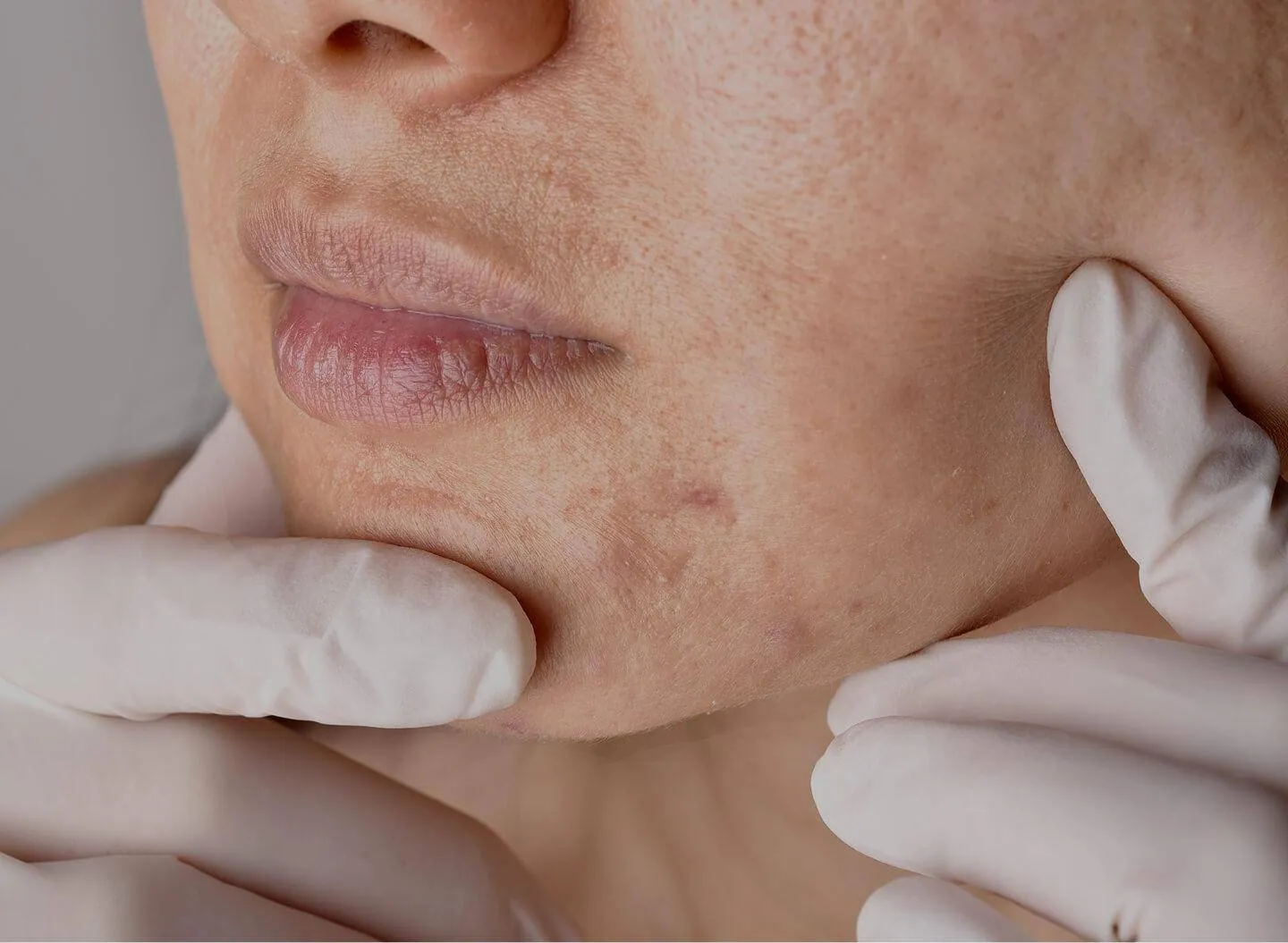 Acne scarring