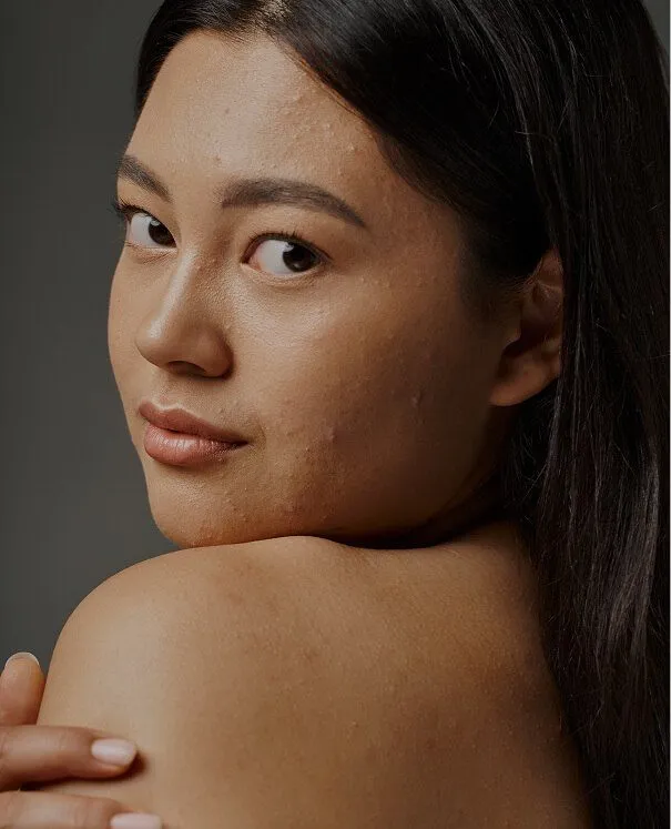 Acne Acne - rtwskin clinic
