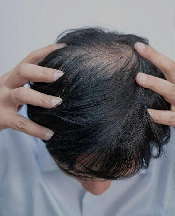 Alopecia small Alopecia - rtwskin clinic