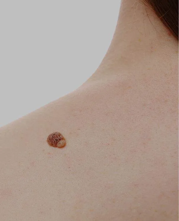 Birthmark small