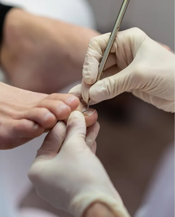 Fungal Nail Fungal Nail - rtwskin clinic
