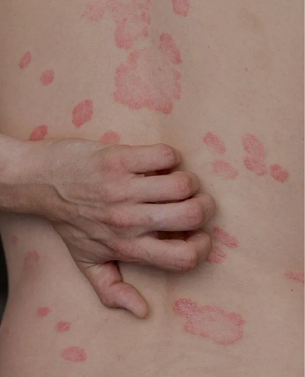 Psoriasis small Psoriasis - rtwskin clinic