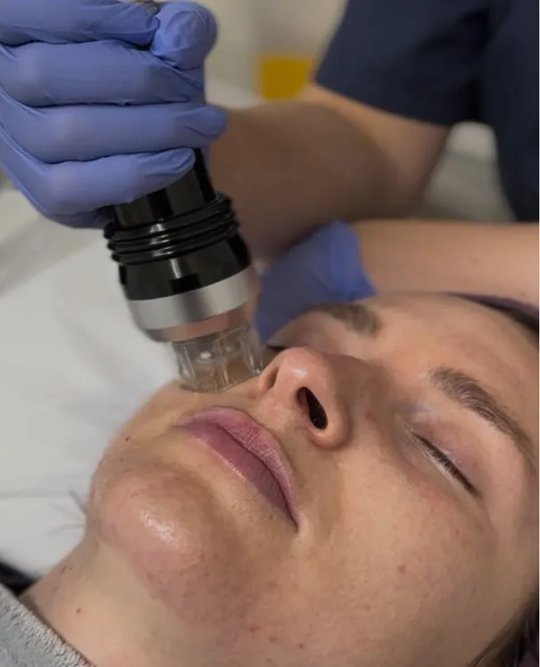 RF Microneedling & Dermaroller small