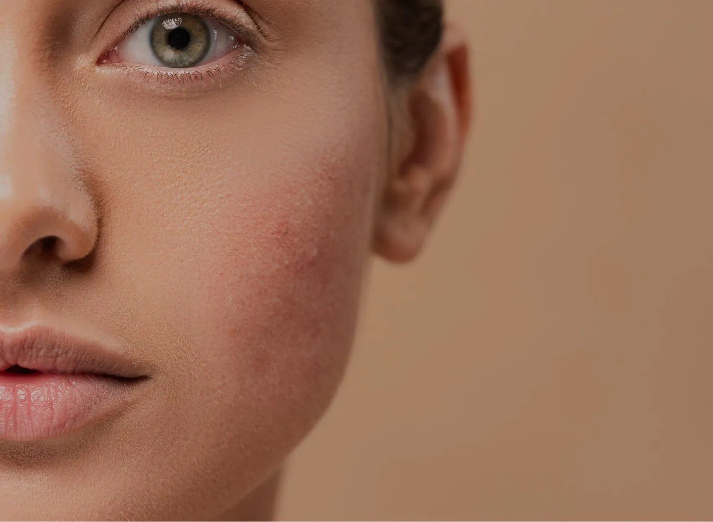 Rosacea