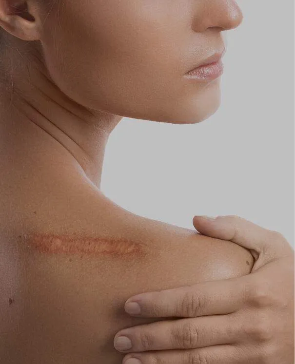 Scar Revision small