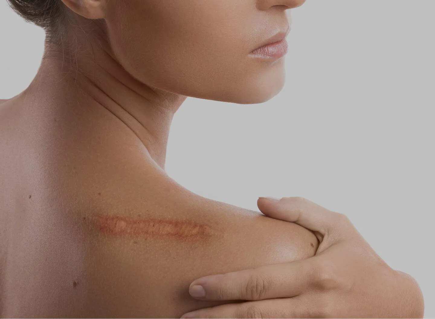 Scar Revision