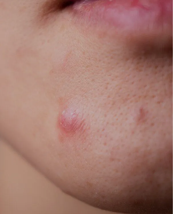 Spot Injections small