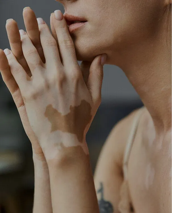 Vitiligo Vitiligo - rtwskin clinic