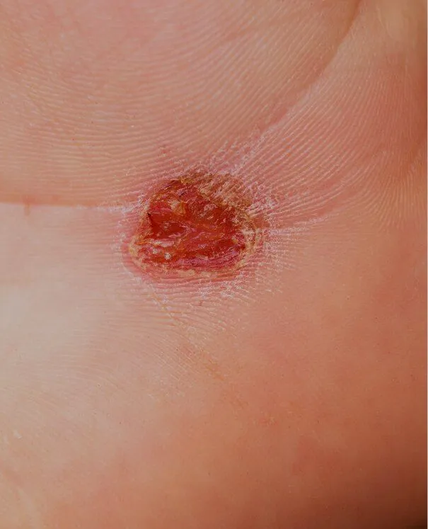 Wart and Verucca small Wart and Verucca - rtwskin clinic