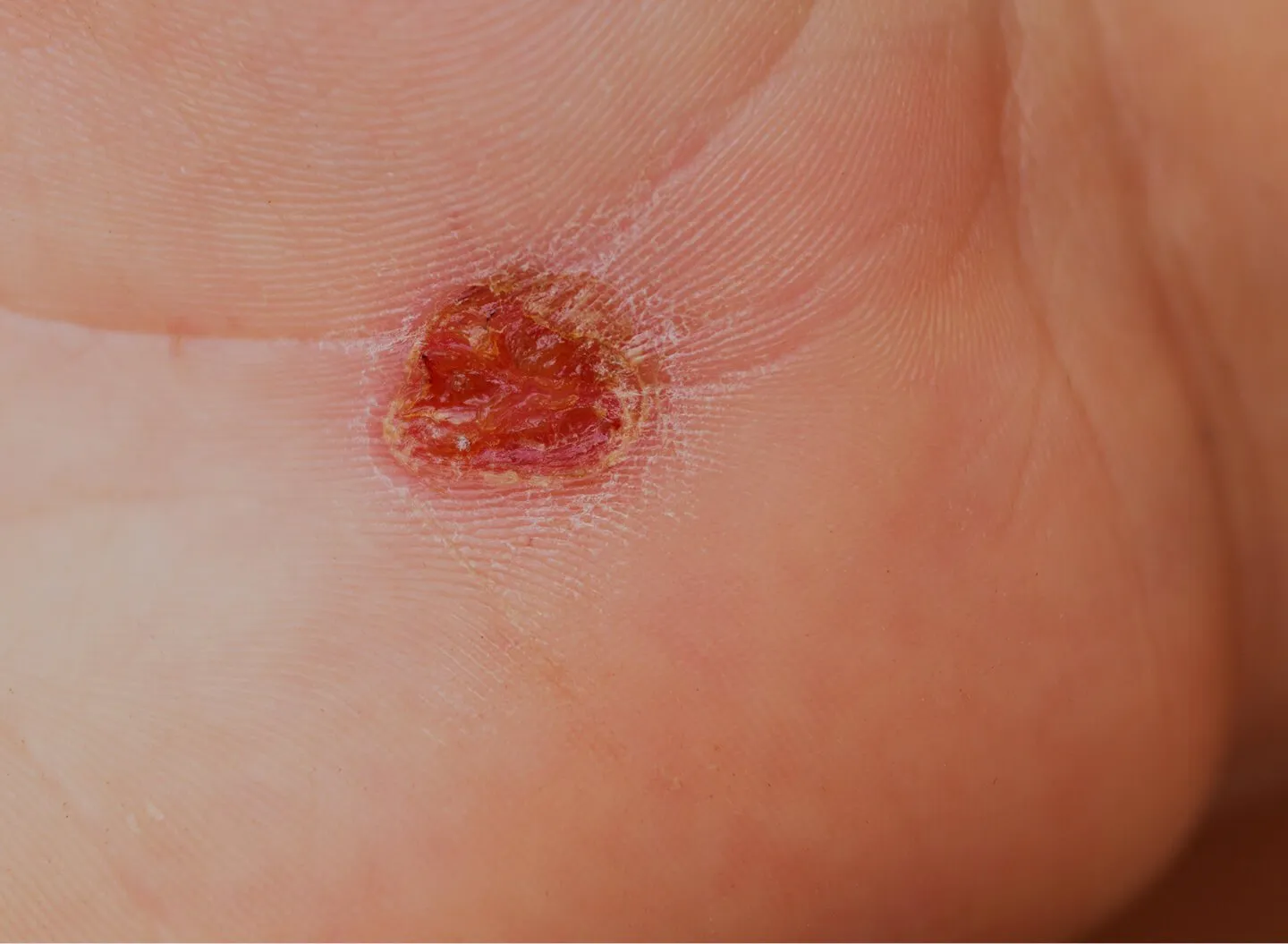 Wart and Verucca