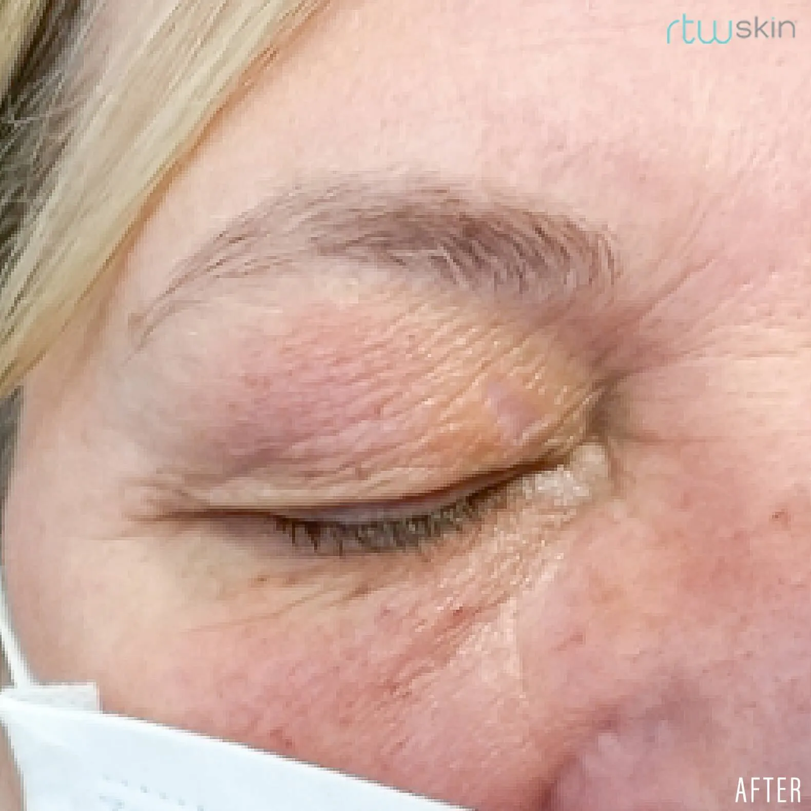 Xanthelasma treatment in action after result