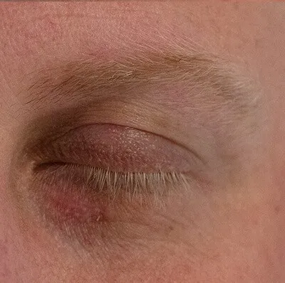 Xanthelasma treatment in action after result