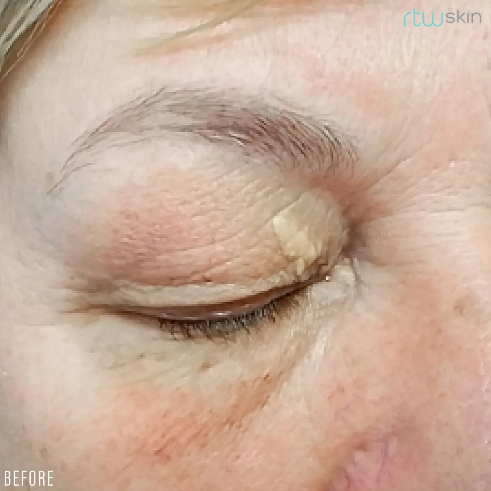 Xanthelasma treatment in action before result