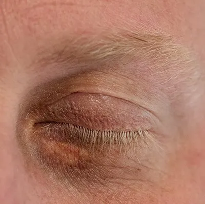 Xanthelasma treatment in action before result
