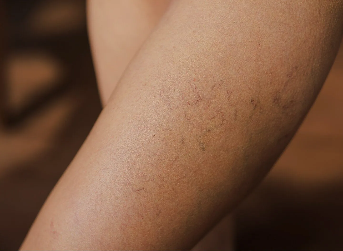 Thread Vein Removal - rtwskin clinic