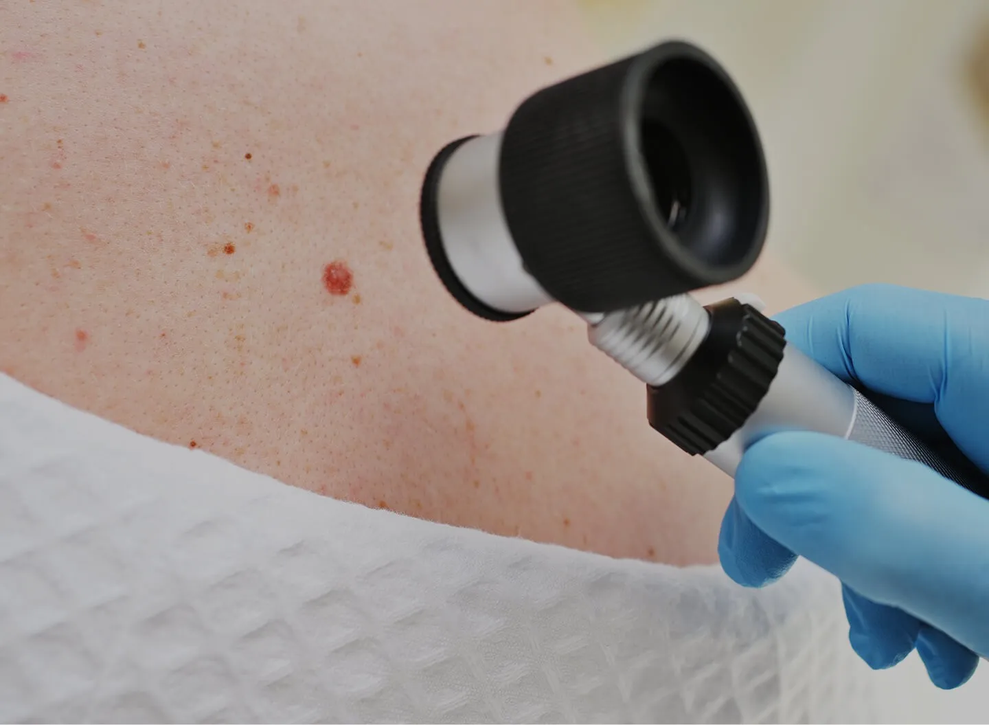 Skin Benign Growths