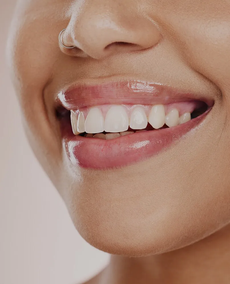 Teeth Whitening