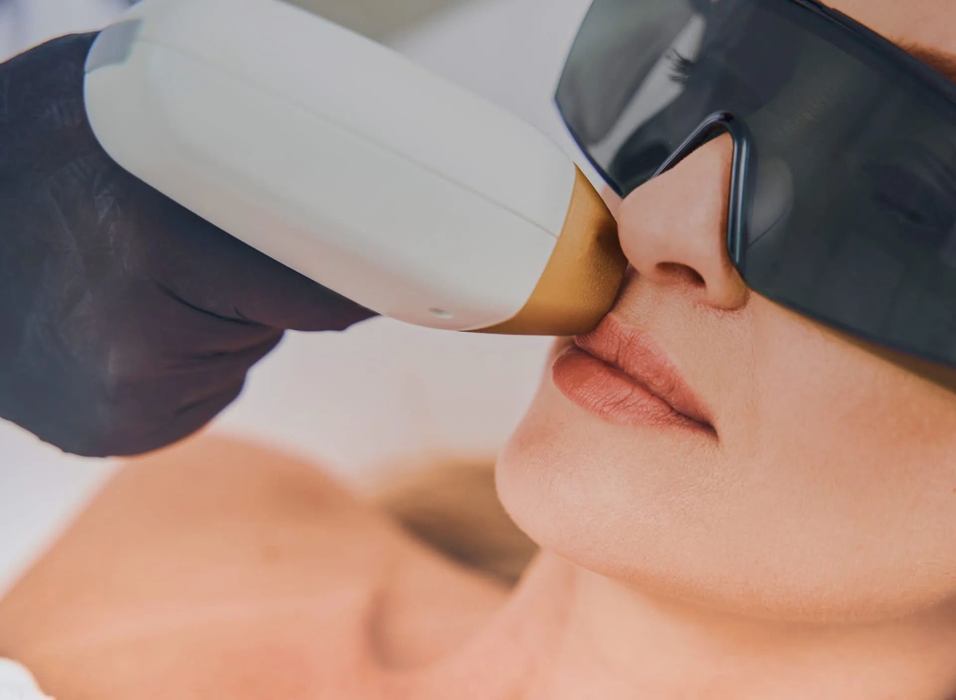 Laser Hair Removal Treatment