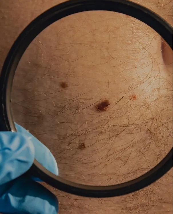 Biopsying a Moleas small