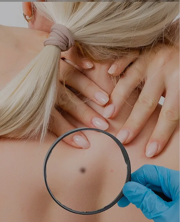 Moles Removal small