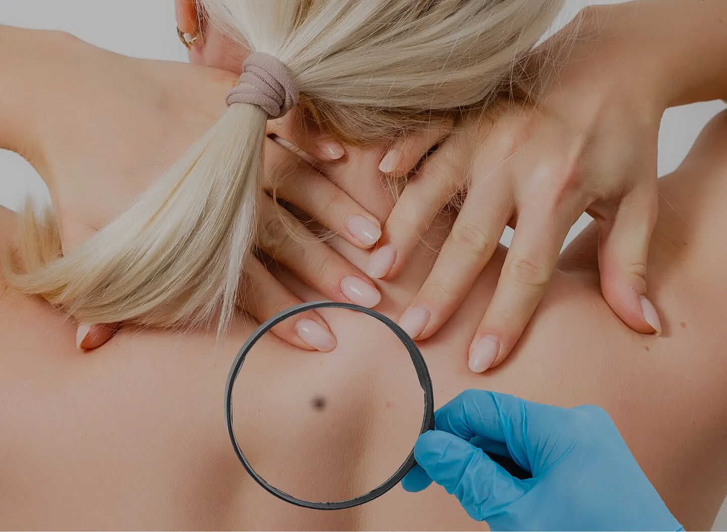 Moles Removal