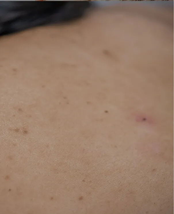 Skin Cyst small