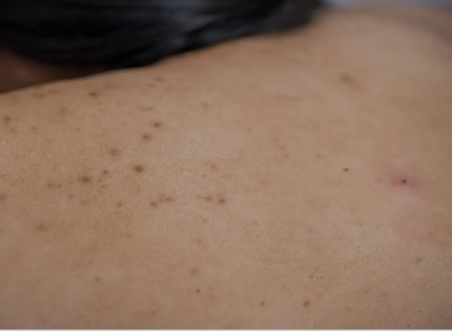 Skin cyst