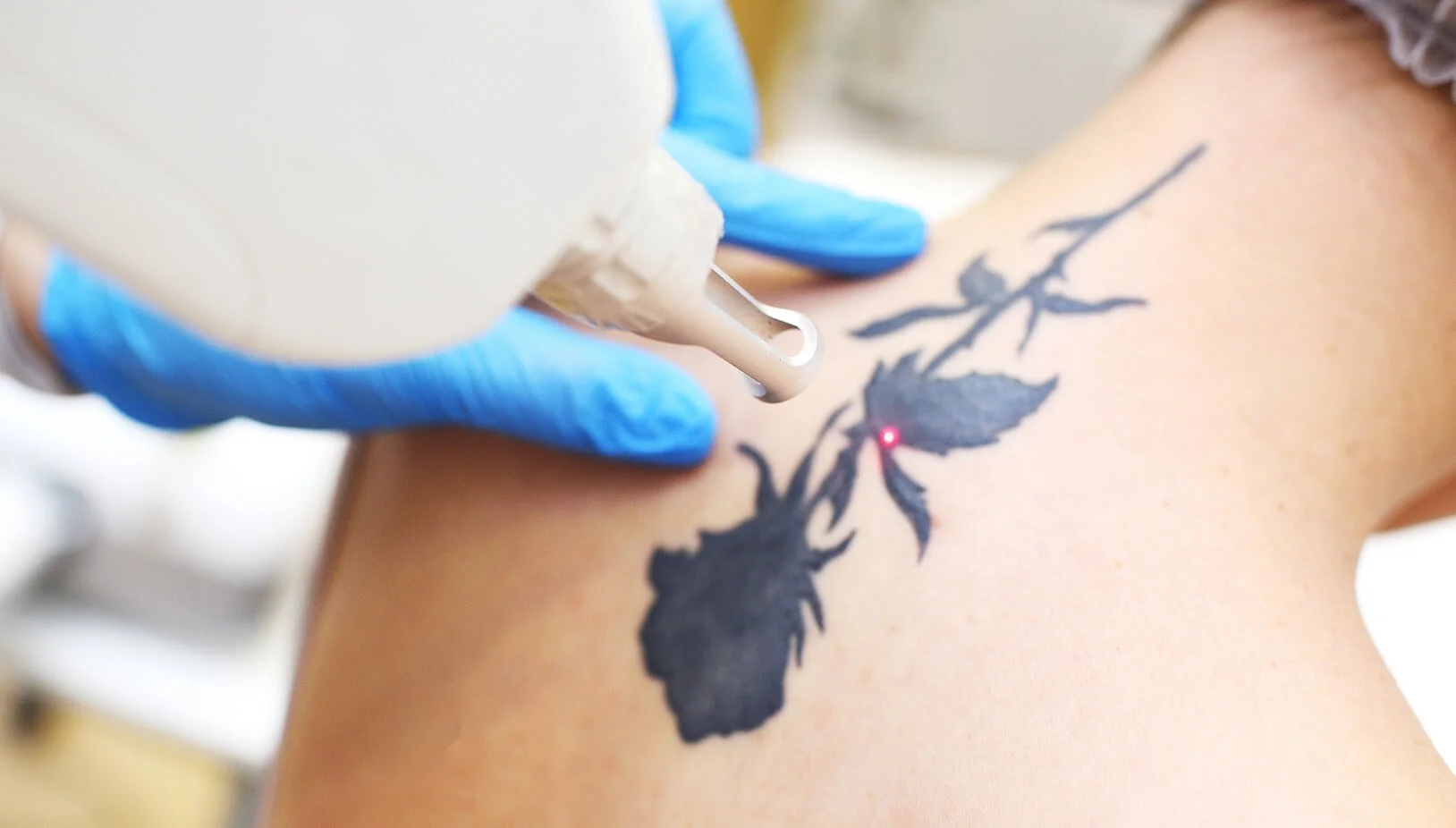 <ul>
<li>
<p data-path-to-node="15,0,0">Multi-coloured tattoo removal</p>
</li>
<li>
<p data-path-to-node="15,1,0">Black, blue, and green ink targeting</p>
</li>
<li>
<p data-path-to-node="15,2,0">Red and warm-toned ink fading</p>
</li>
<li>
<p data-path-to-node="15,3,0">Amateur and professional tattoo removal</p>
</li>
</ul>
 image